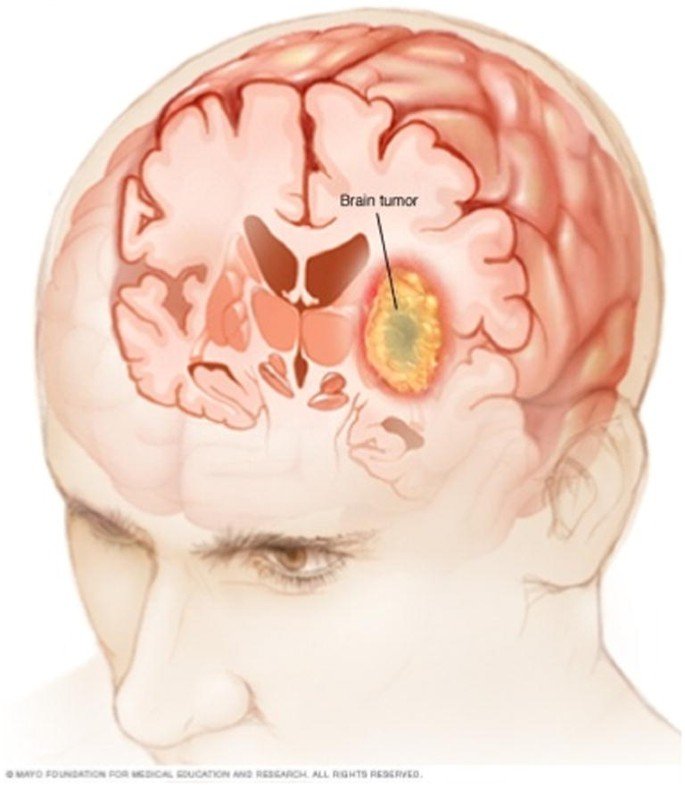 How to Detect a Brain Tumor at Home?