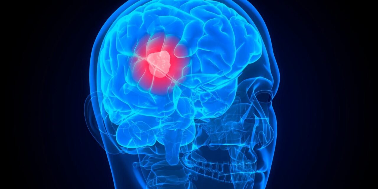 How to Detect a Brain Tumor at Home? Symptoms and Warning Signs