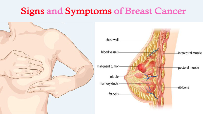 Symptoms of Breast Cancer