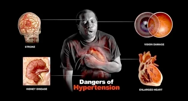 Why Is Hypertension More Common in Black?