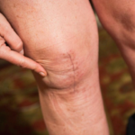 What is Post Surgical Rehabilitation & Why You Need Physical Therapy