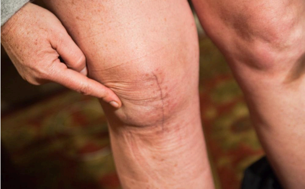 What is Post Surgical Rehabilitation & Why You Need Physical Therapy