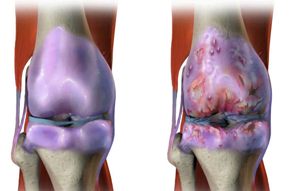 Physiotherapy for Knee