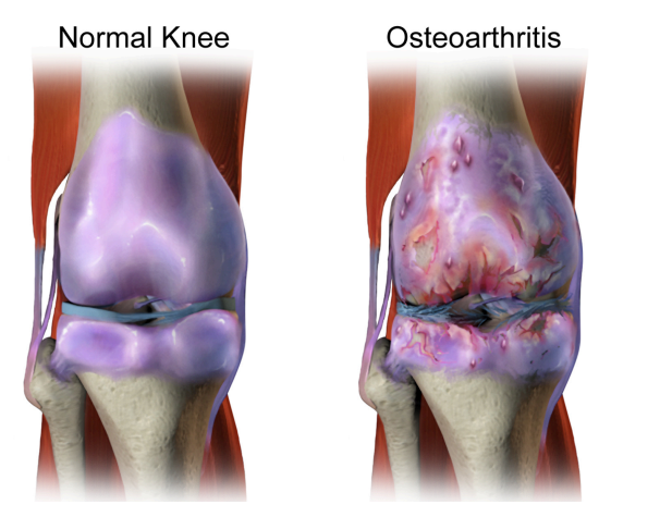 Physiotherapy for Knee